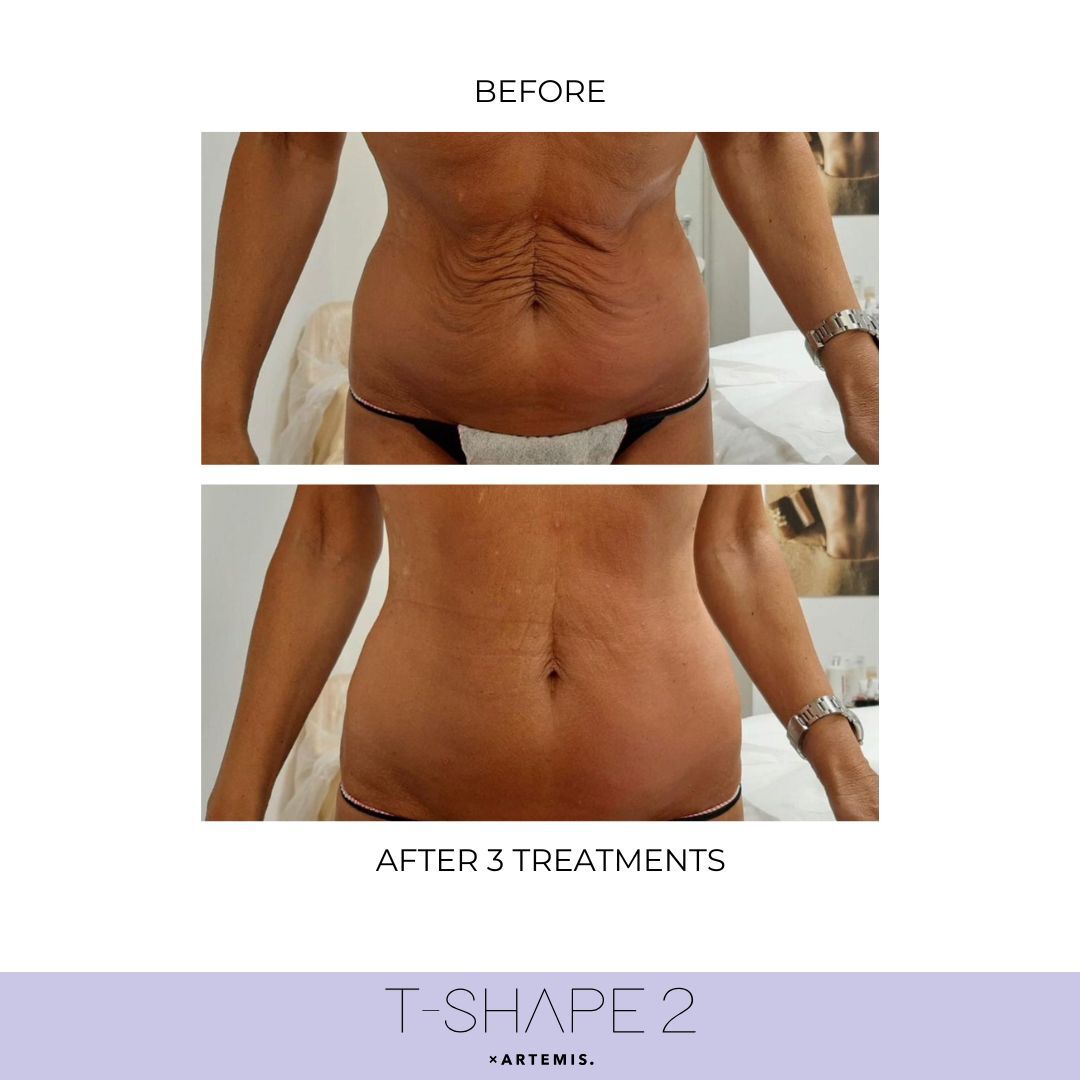 T-Shape 2 results — Abdomen at iCRYO St Johns