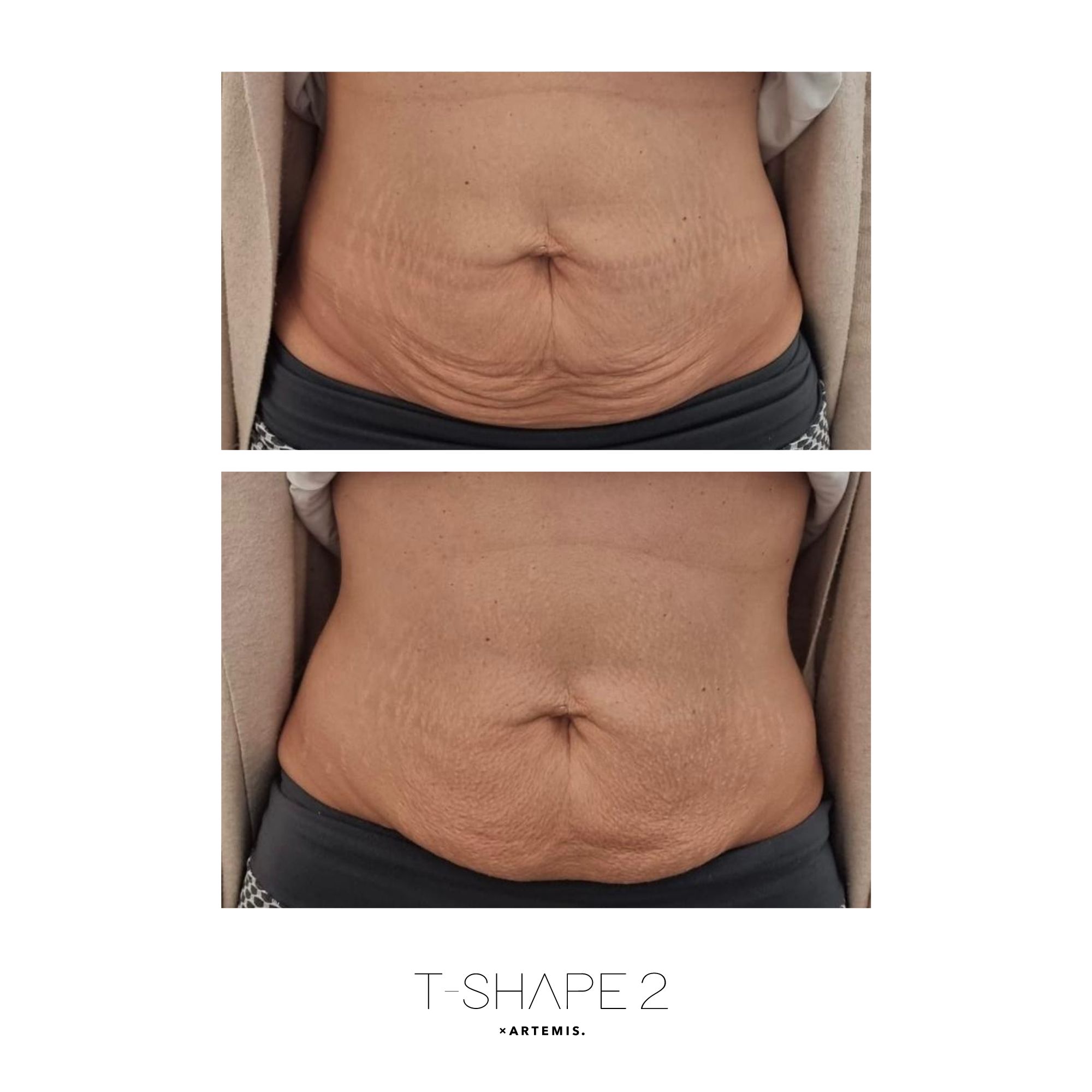 T-Shape 2 results — Abs at iCRYO St Johns
