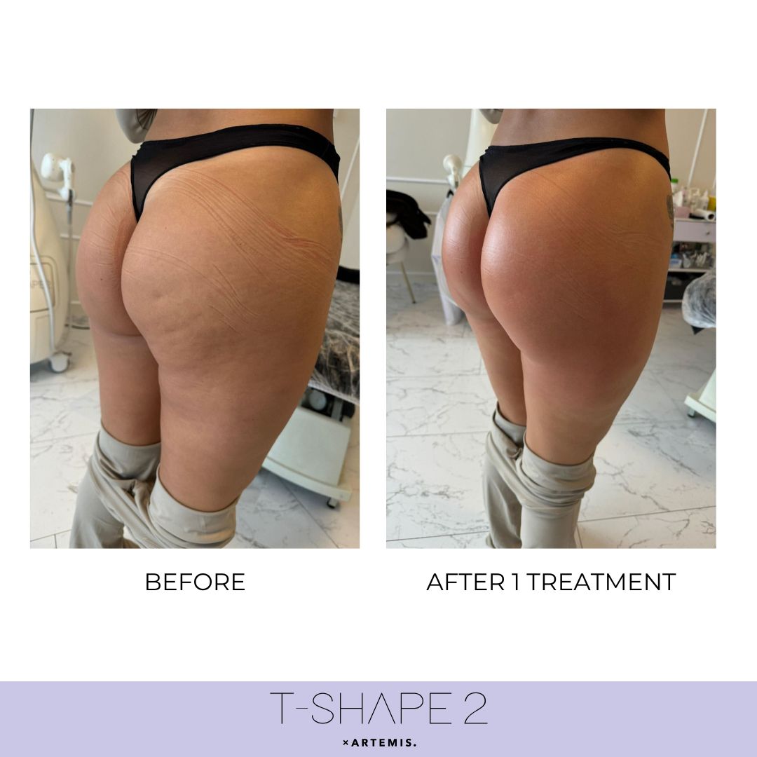 T-Shape 2 results — Body at iCRYO St Johns