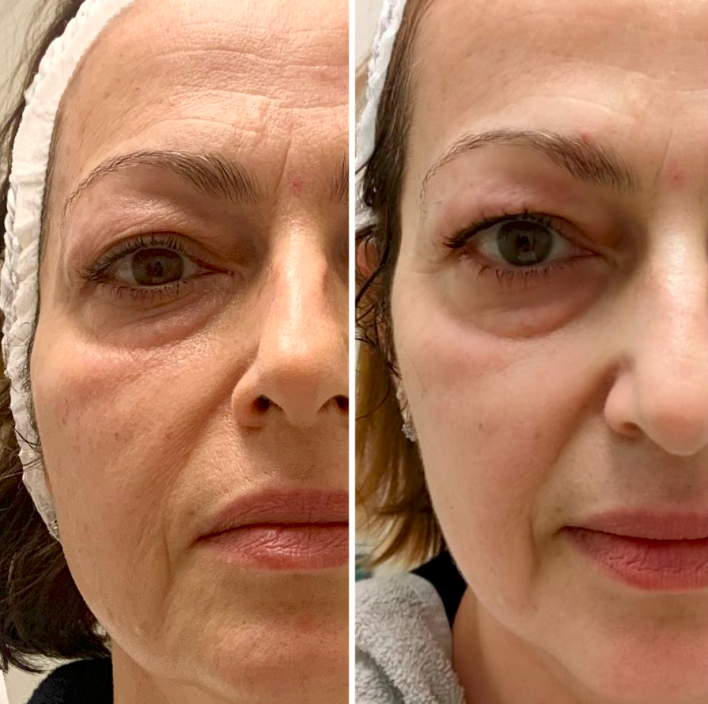 T-Shape 2 Facial results — Eye & Cheek Area at iCRYO St Johns