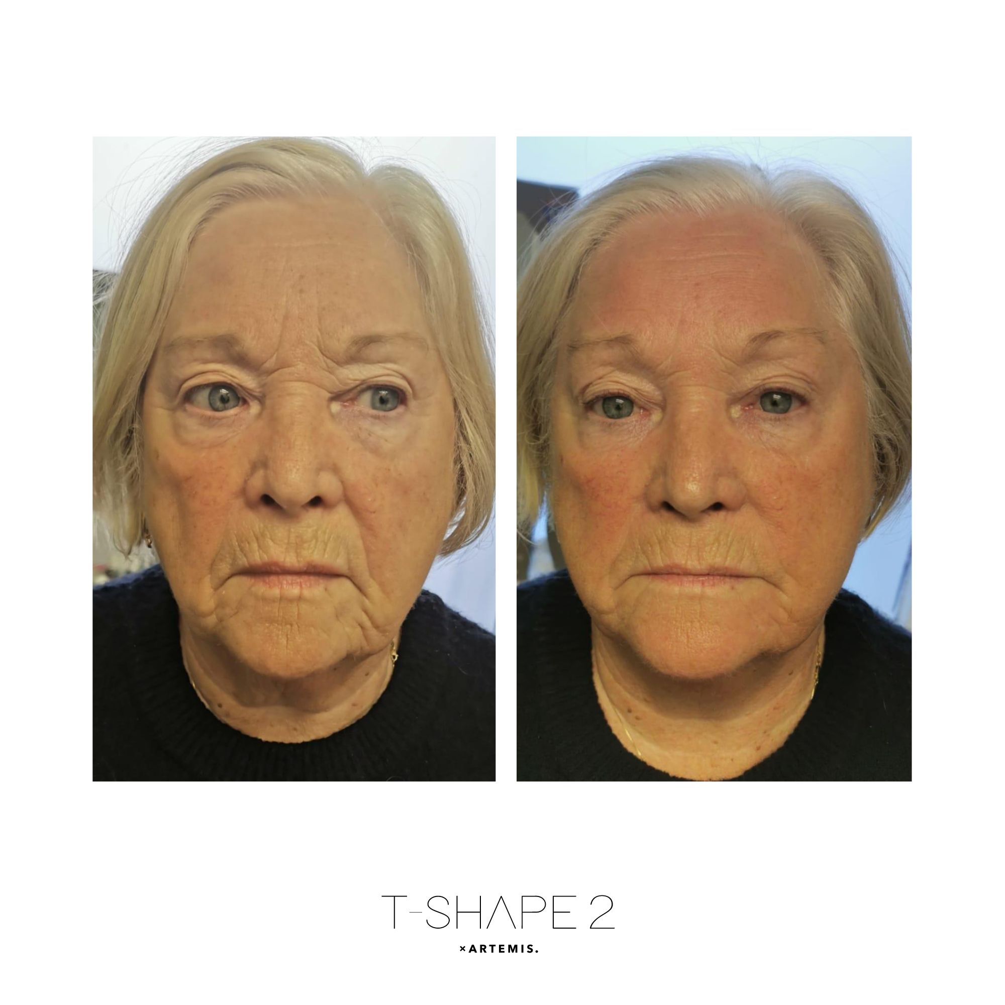 T-Shape 2 results — Face at iCRYO St Johns