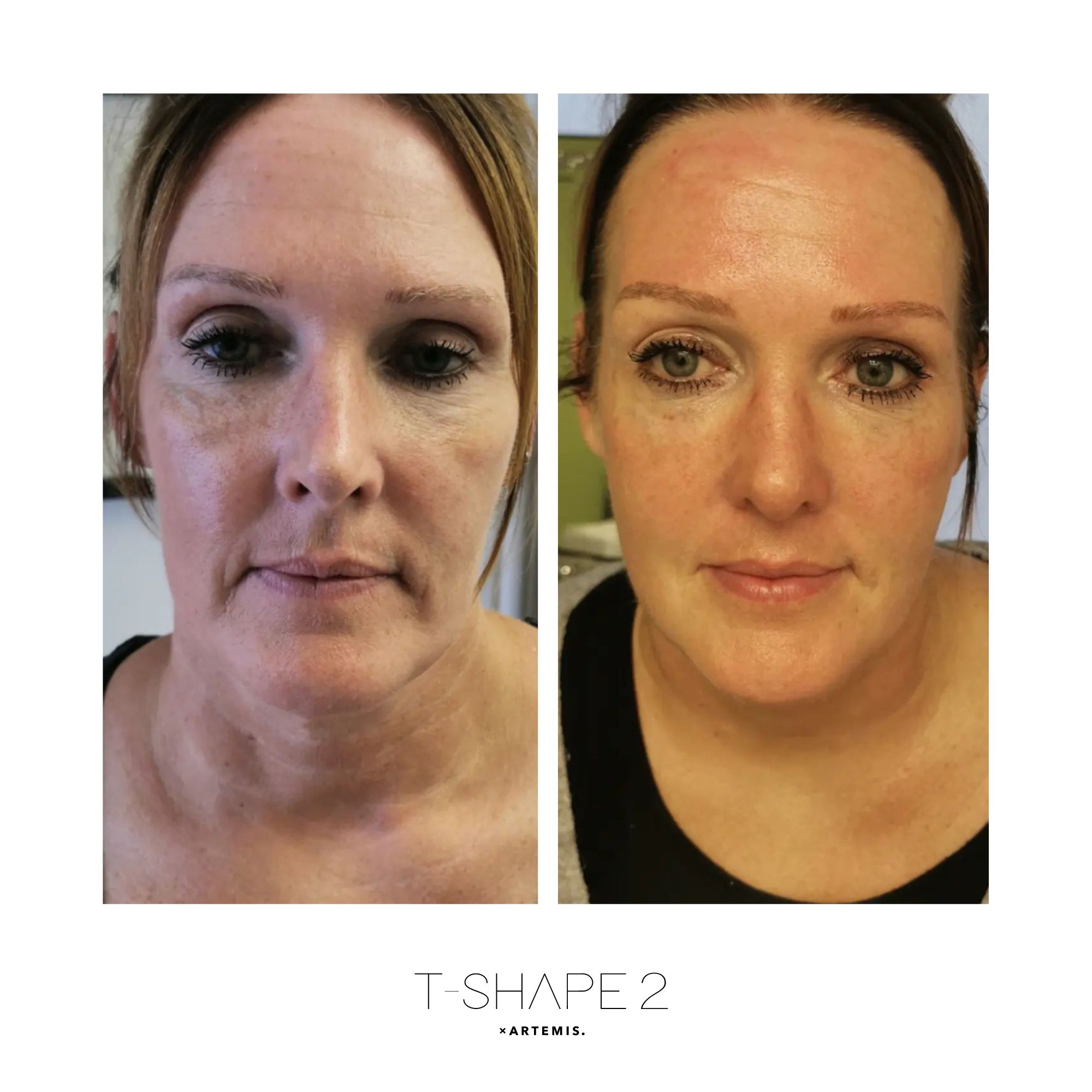 T-Shape 2 results — Face at iCRYO St Johns