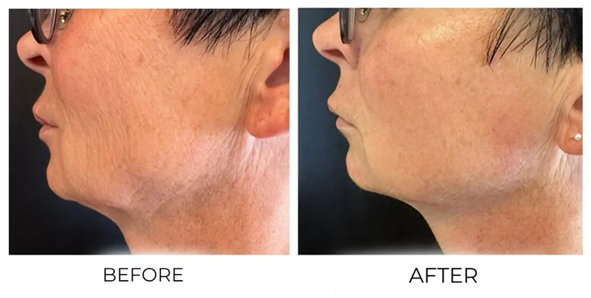 T-Shape 2 Facial results — Face & Neck at iCRYO St Johns