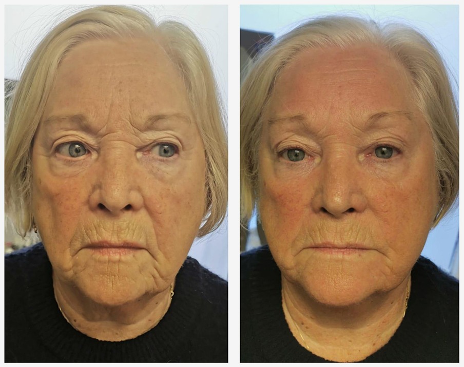T-Shape 2 Facial results — Full Face at iCRYO St Johns