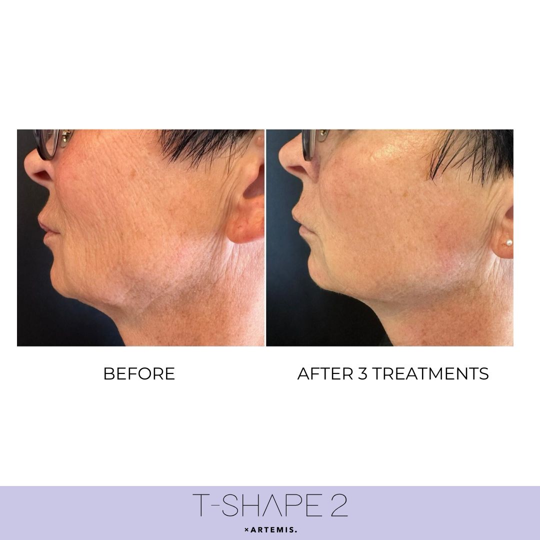 T-Shape 2 results — Neck at iCRYO St Johns