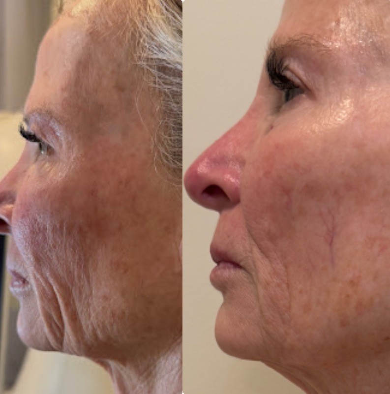 T-Shape 2 Facial results — Face & Jawline at iCRYO St Johns